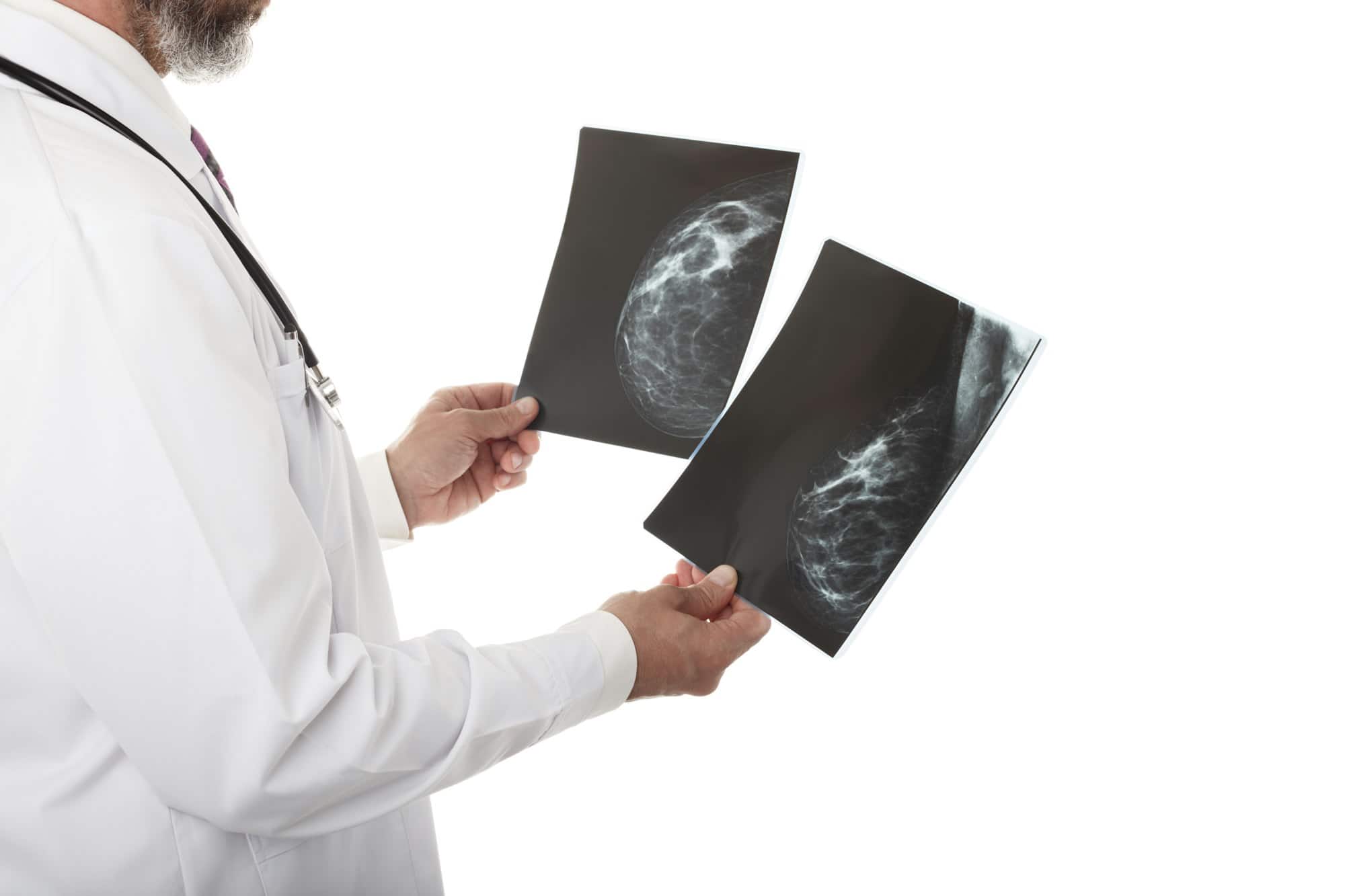 Doctor with breast Xray